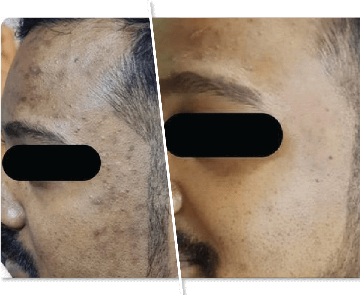Men Before and After Skin Treatment